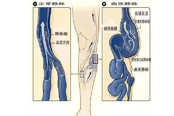 下肢毛细血管扩张症与下肢静脉曲张的区别