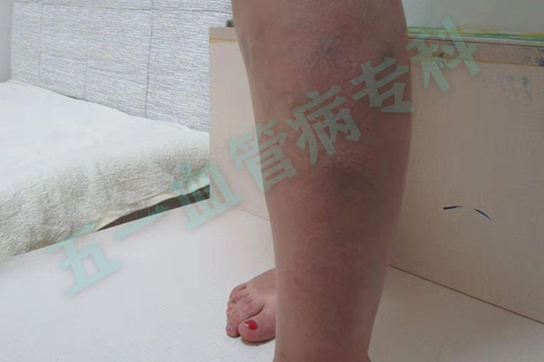 静脉曲张和血栓性静脉炎有什么区别？大连静脉曲张专科医院五一静脉曲张专科医院结合气候自然环境对这两种疾病进行系统分析！