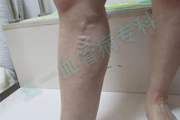 静脉曲张属于血管炎症吗葫芦岛静脉曲张专科医院告诉你血管炎症如何预防