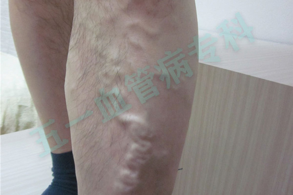 下肢静脉曲张和下肢动脉硬化一定要分清了!如何治疗锦州下肢动脉硬化