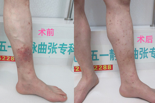 沈阳静脉曲张专科医院与大连静脉曲张专科医院