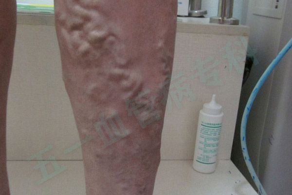 警惕！这些职业和生活习惯，正在悄悄“引爆”你的静脉曲张