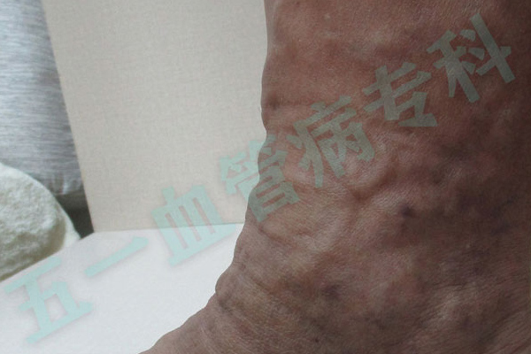 沈阳看静脉曲张医院推荐攻略